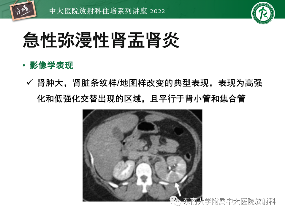 影像PPT - 【PPT】肾盂肾炎的影像表现及鉴别诊断-10