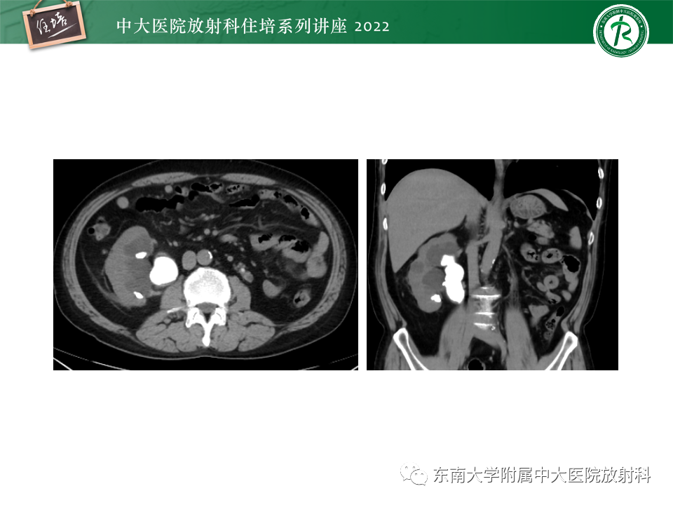 影像PPT - 【PPT】肾盂肾炎的影像表现及鉴别诊断-15