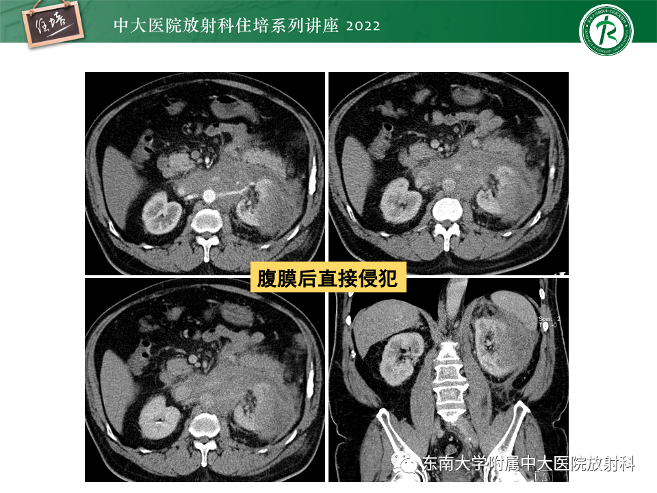 影像PPT - 【PPT】肾盂肾炎的影像表现及鉴别诊断-38