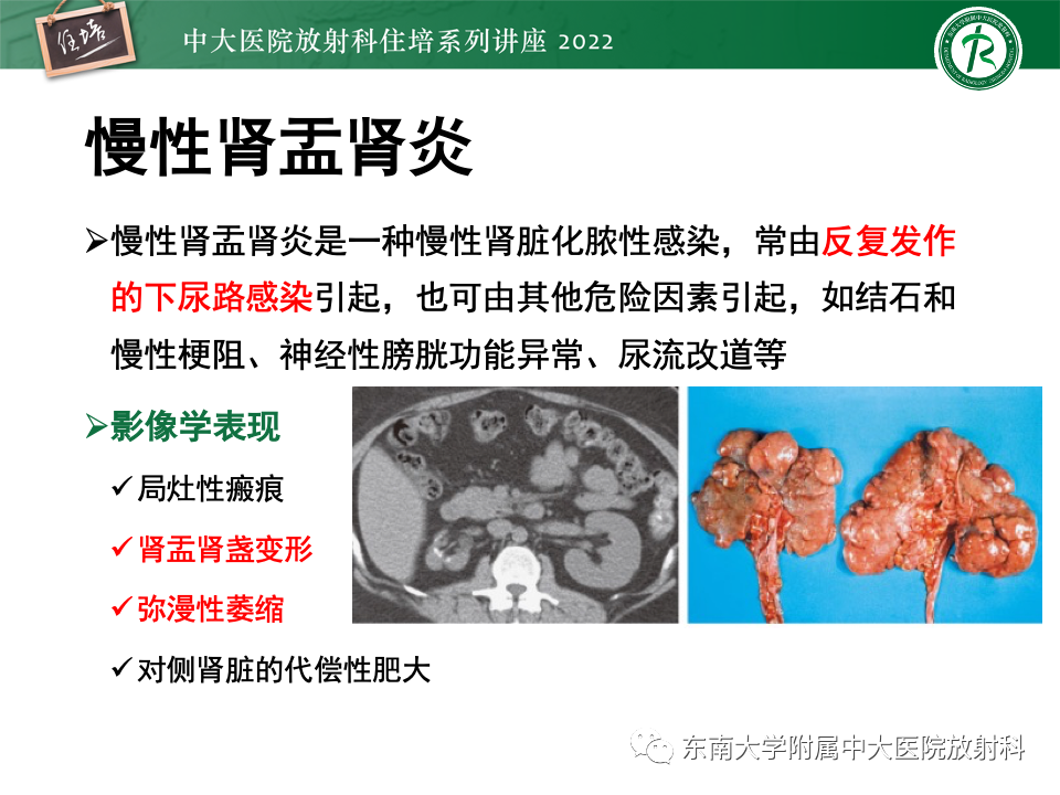 影像PPT - 【PPT】肾盂肾炎的影像表现及鉴别诊断-11