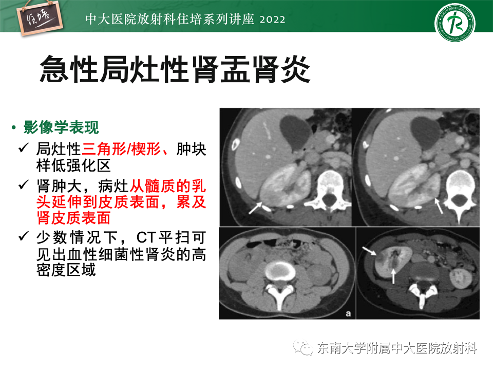 影像PPT - 【PPT】肾盂肾炎的影像表现及鉴别诊断-9