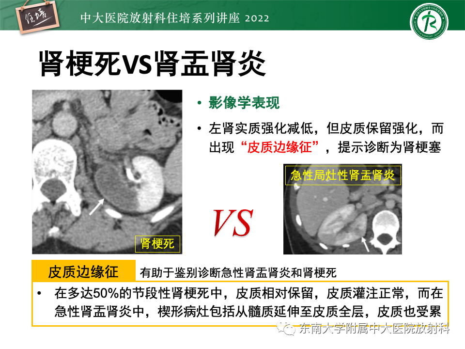 影像PPT - 【PPT】肾盂肾炎的影像表现及鉴别诊断-27