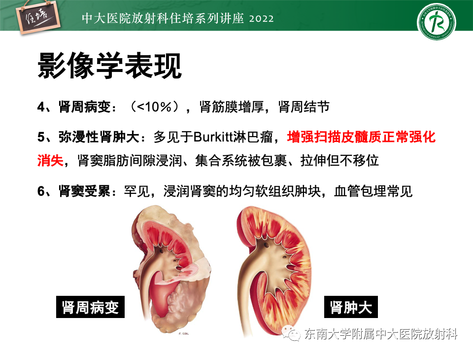 影像PPT - 【PPT】肾盂肾炎的影像表现及鉴别诊断-34