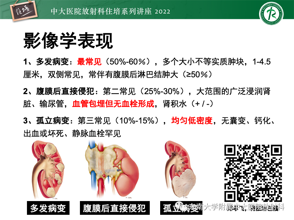 影像PPT - 【PPT】肾盂肾炎的影像表现及鉴别诊断-33