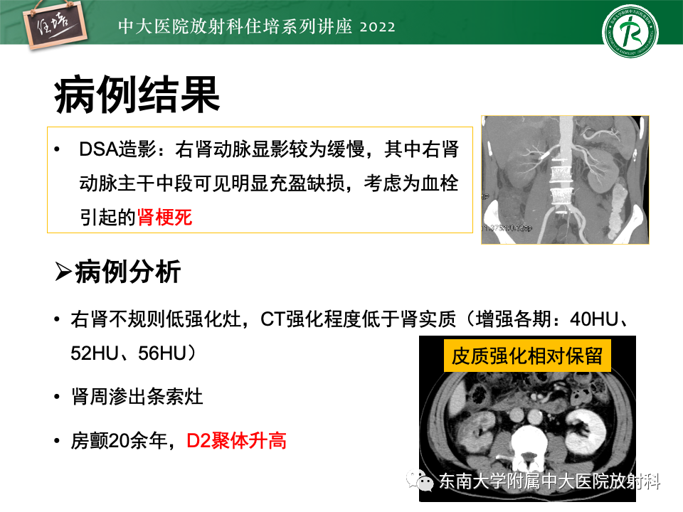 影像PPT - 【PPT】肾盂肾炎的影像表现及鉴别诊断-25