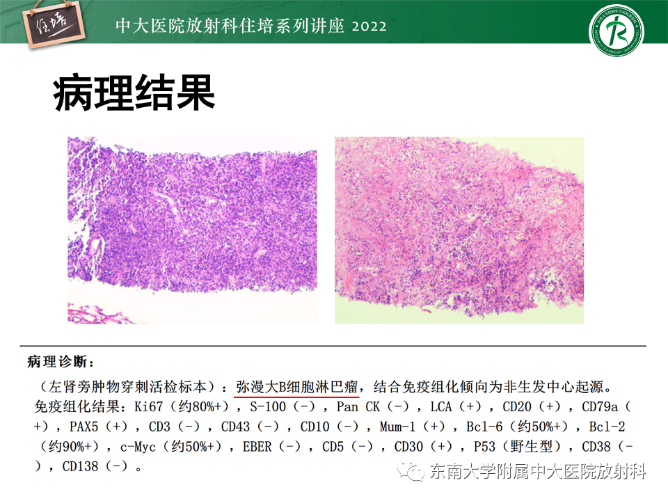 影像PPT - 【PPT】肾盂肾炎的影像表现及鉴别诊断-31
