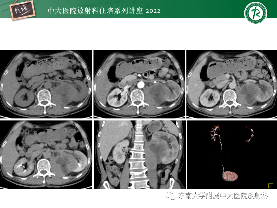 影像PPT - 【PPT】肾盂肾炎的影像表现及鉴别诊断-29