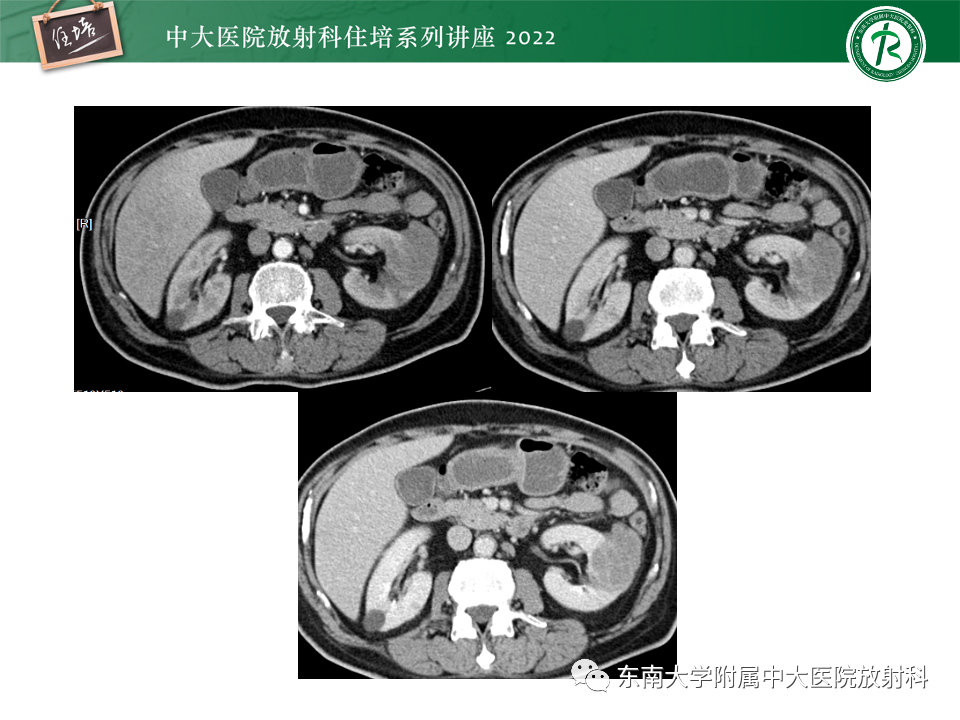 影像PPT - 【PPT】肾盂肾炎的影像表现及鉴别诊断-40