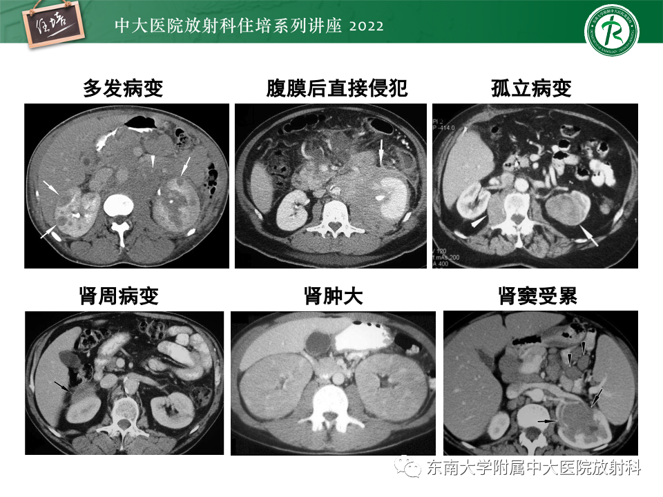 影像PPT - 【PPT】肾盂肾炎的影像表现及鉴别诊断-35