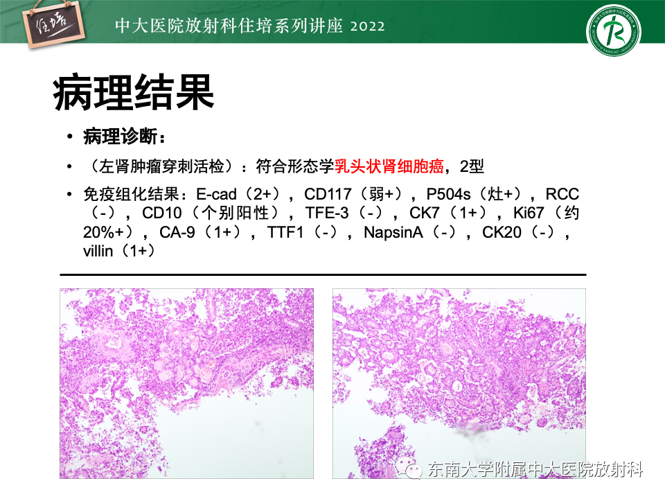 影像PPT - 【PPT】肾盂肾炎的影像表现及鉴别诊断-41
