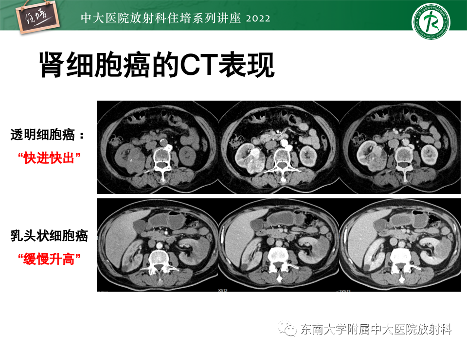 影像PPT - 【PPT】肾盂肾炎的影像表现及鉴别诊断-44