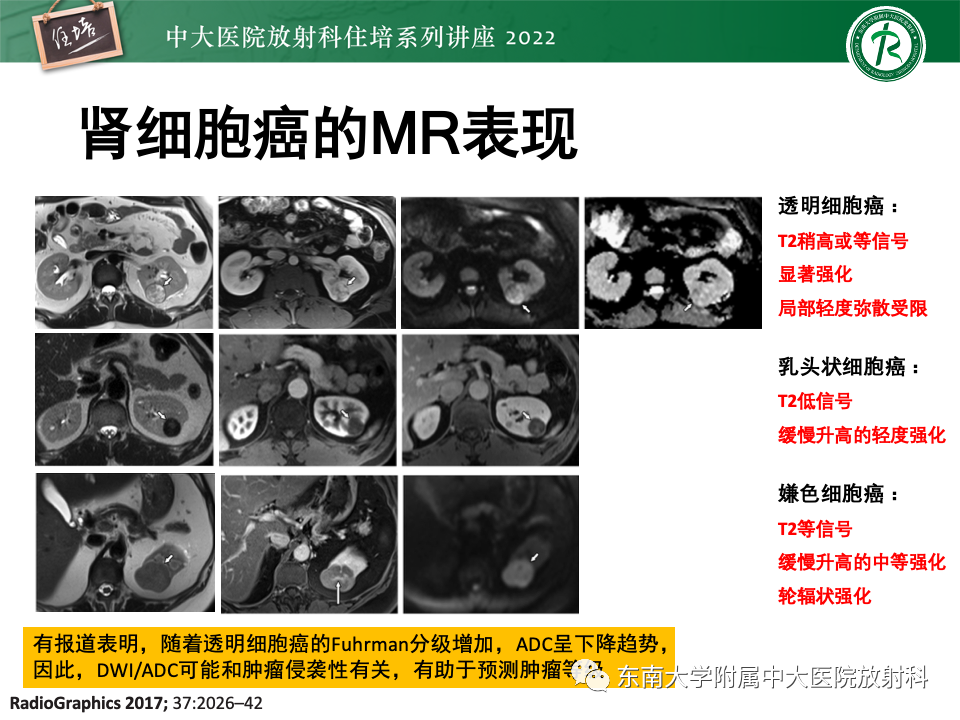 影像PPT - 【PPT】肾盂肾炎的影像表现及鉴别诊断-45