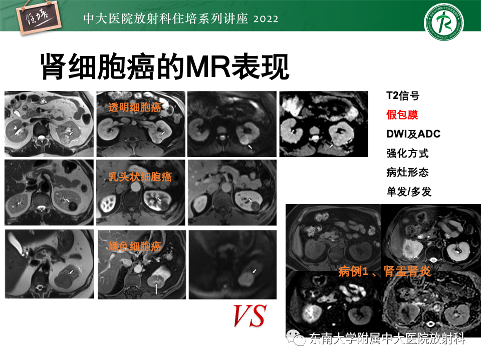 影像PPT - 【PPT】肾盂肾炎的影像表现及鉴别诊断-46