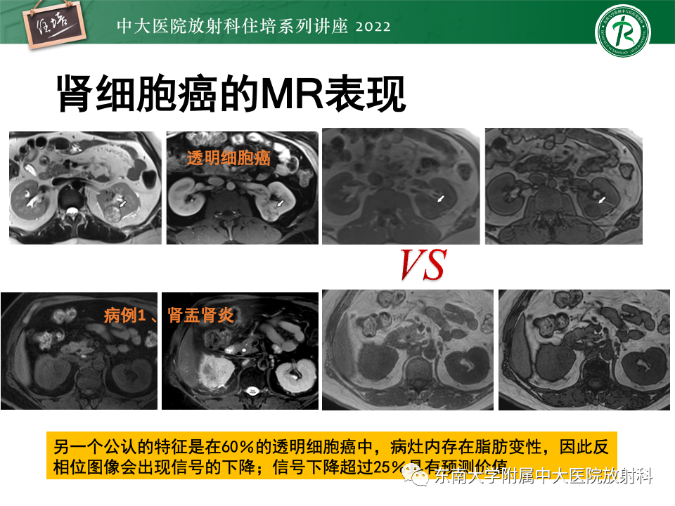 影像PPT - 【PPT】肾盂肾炎的影像表现及鉴别诊断-47