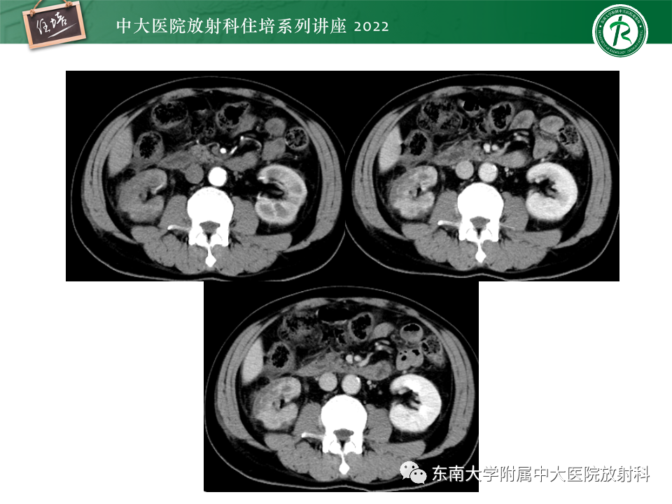 影像PPT - 【PPT】肾盂肾炎的影像表现及鉴别诊断-24
