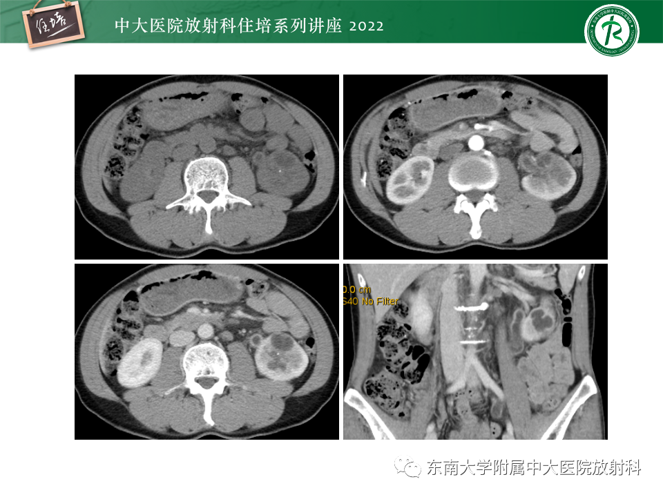 影像PPT - 【PPT】肾盂肾炎的影像表现及鉴别诊断-49