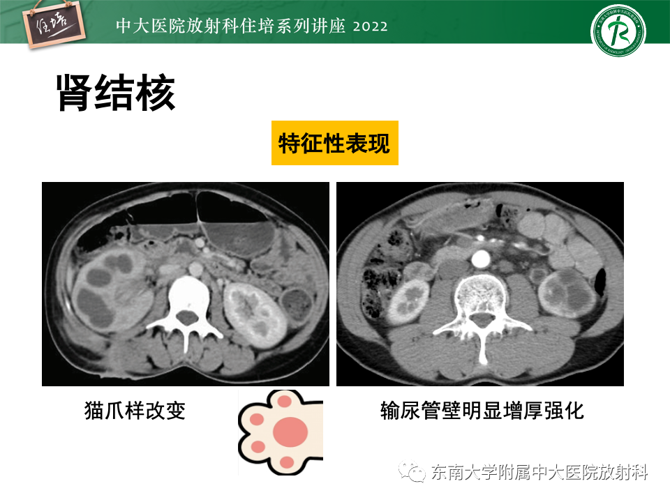 影像PPT - 【PPT】肾盂肾炎的影像表现及鉴别诊断-52