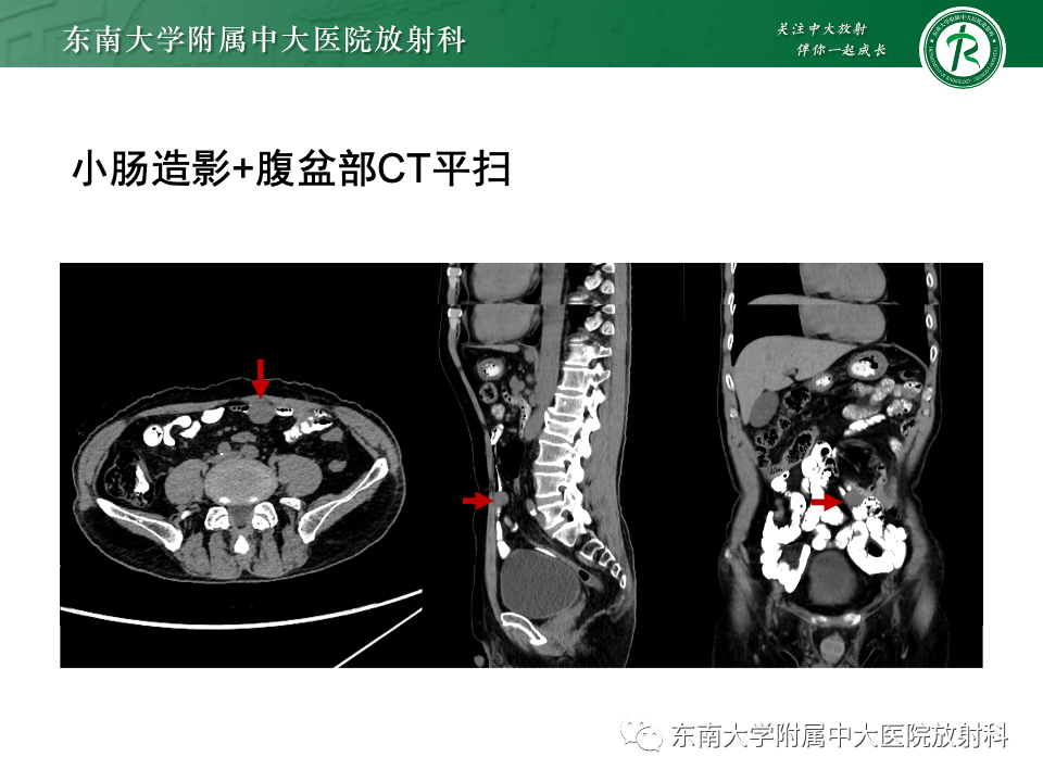 影像PPT - 【PPT】小肠间质瘤-6