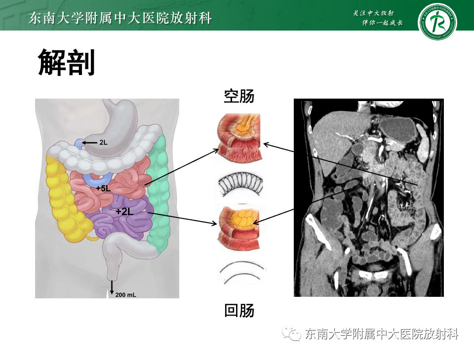 影像PPT - 【PPT】小肠间质瘤-10