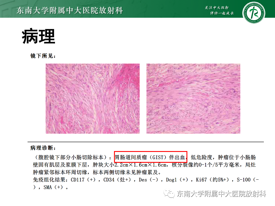 影像PPT - 【PPT】小肠间质瘤-8