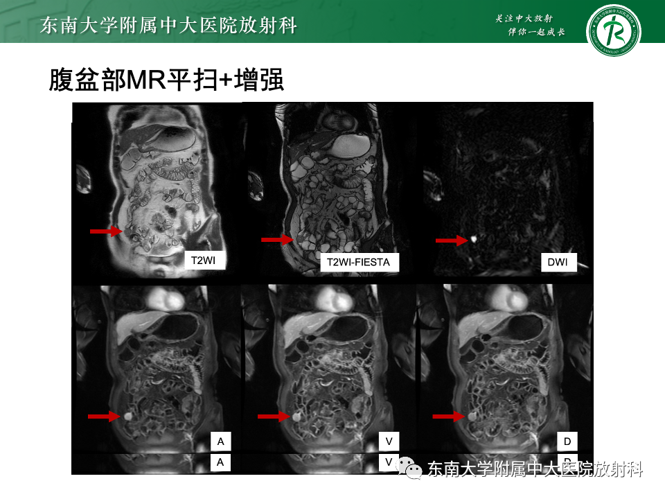 影像PPT - 【PPT】小肠间质瘤-5