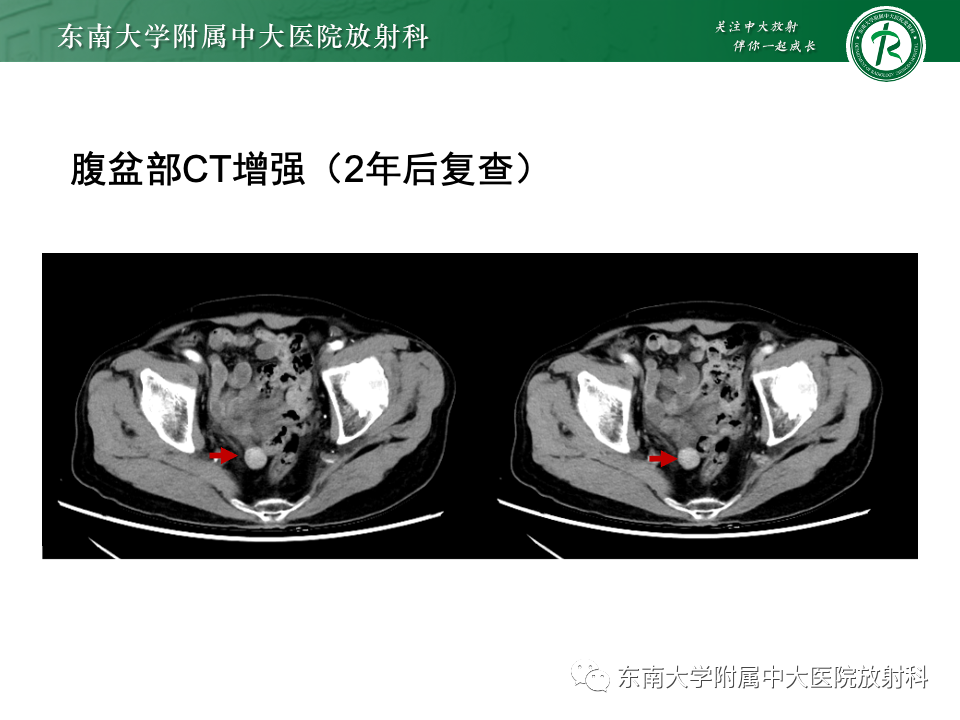影像PPT - 【PPT】小肠间质瘤-7