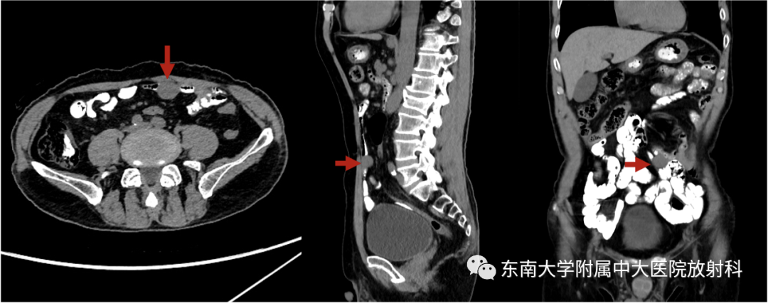 影像PPT - 【PPT】小肠间质瘤-2
