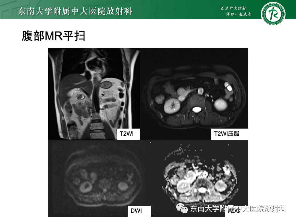 影像PPT - 【PPT】小肠间质瘤-19