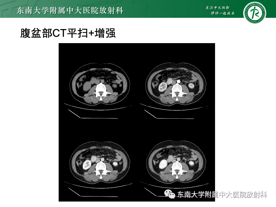影像PPT - 【PPT】小肠间质瘤-18