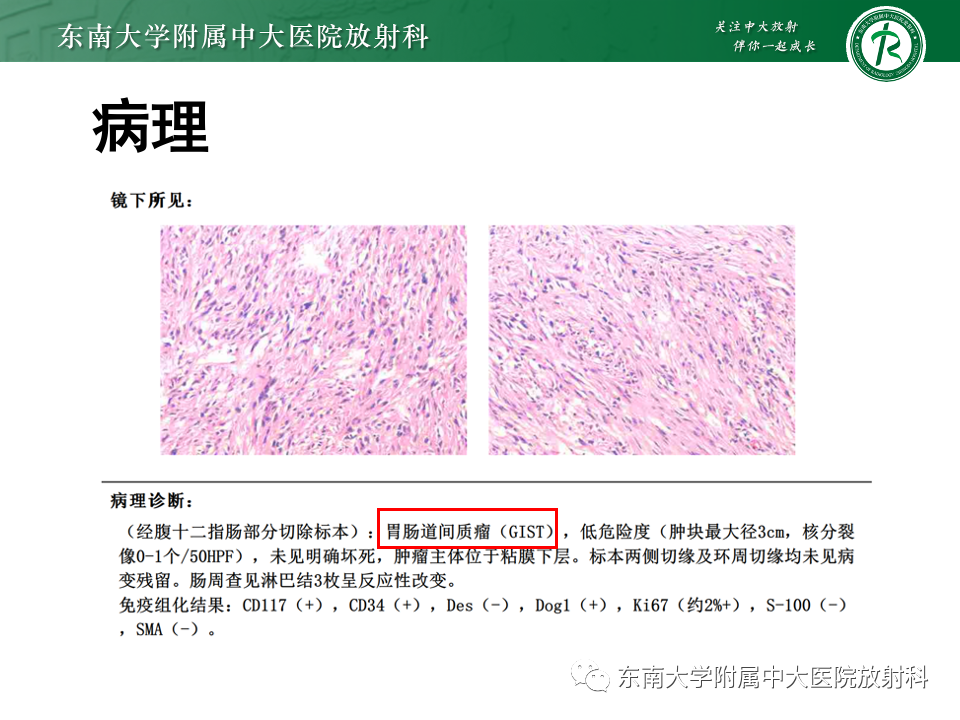 影像PPT - 【PPT】小肠间质瘤-20