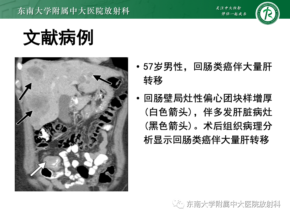 影像PPT - 【PPT】小肠间质瘤-22