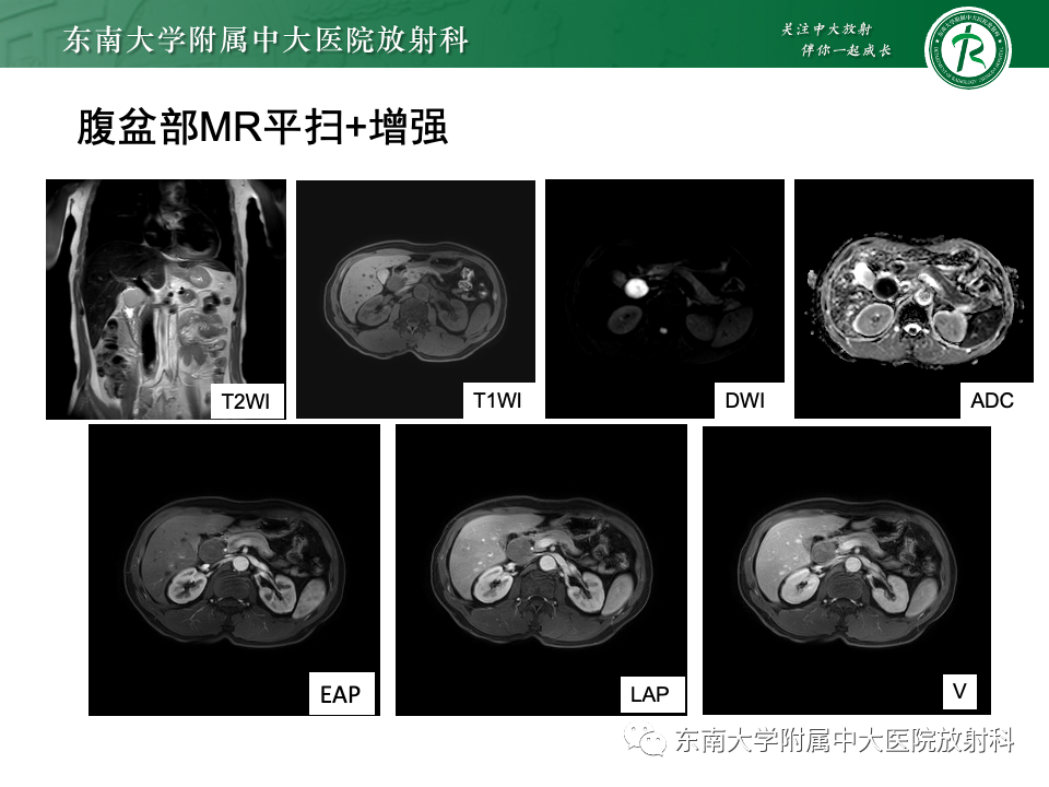 影像PPT - 【PPT】小肠间质瘤-25