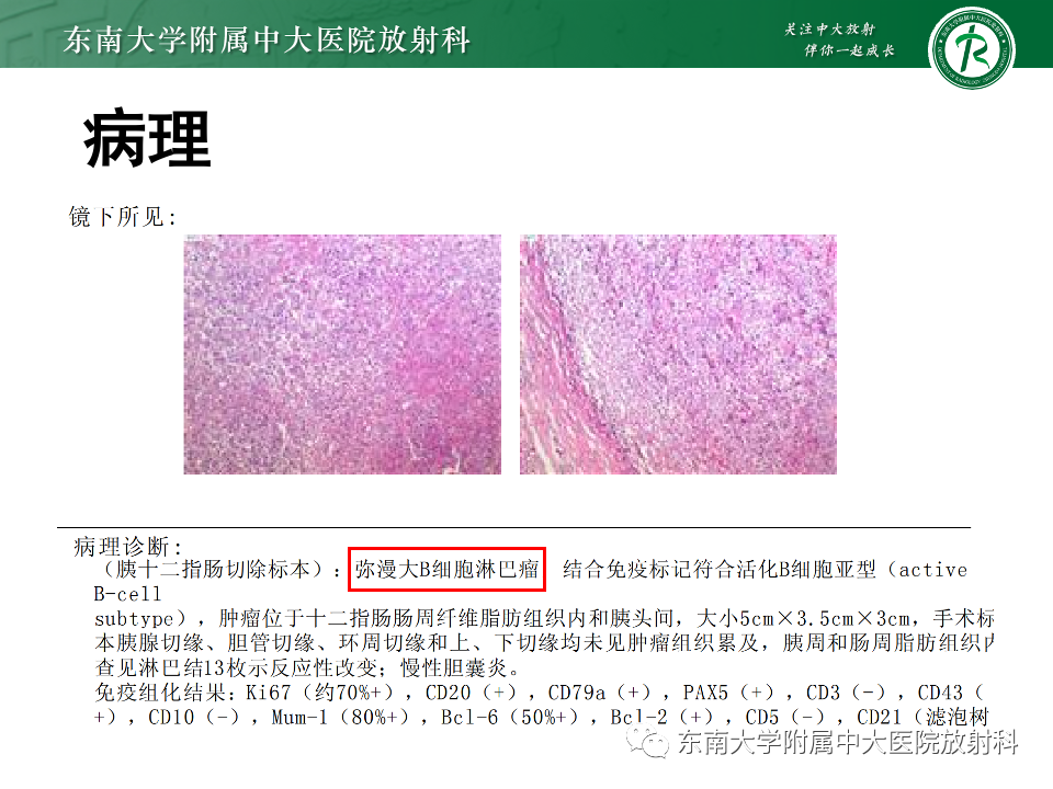 影像PPT - 【PPT】小肠间质瘤-27