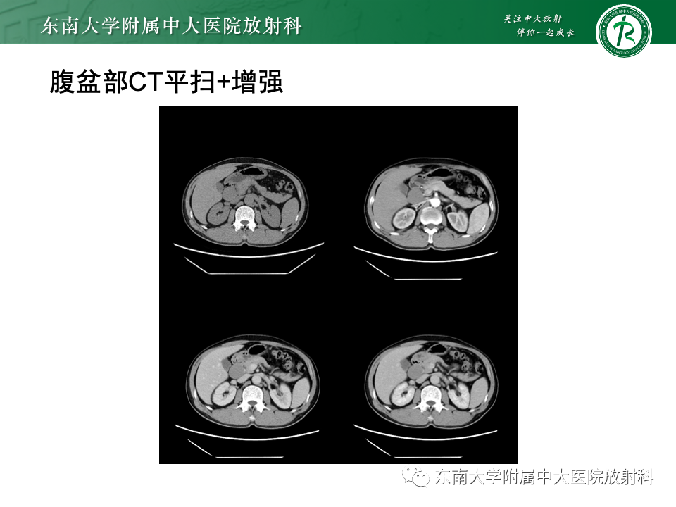 影像PPT - 【PPT】小肠间质瘤-26