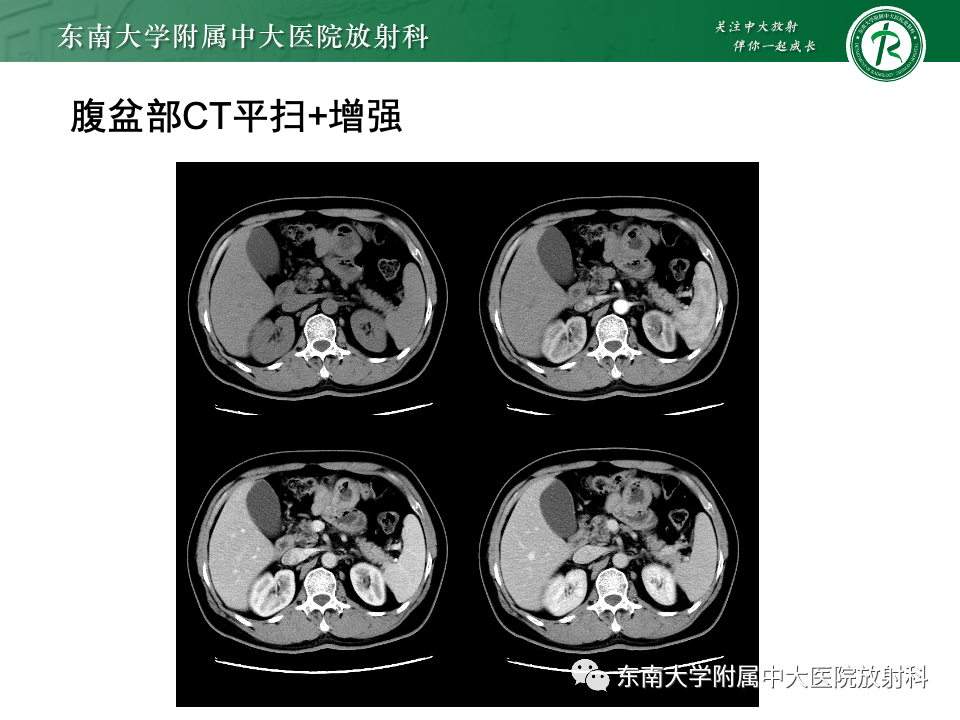 影像PPT - 【PPT】小肠间质瘤-30