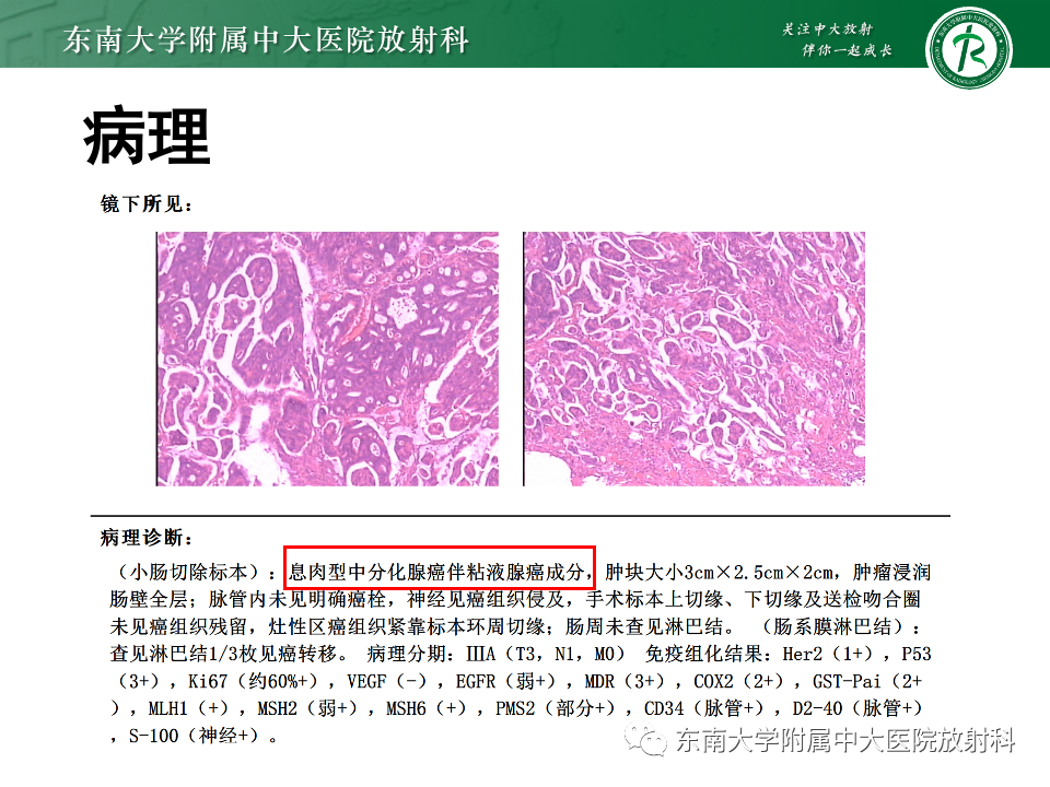 影像PPT - 【PPT】小肠间质瘤-31