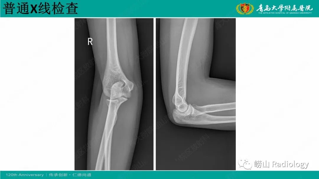影像PPT - 【病例】肘关节腱鞘纤维瘤1例X线CT及MR-3