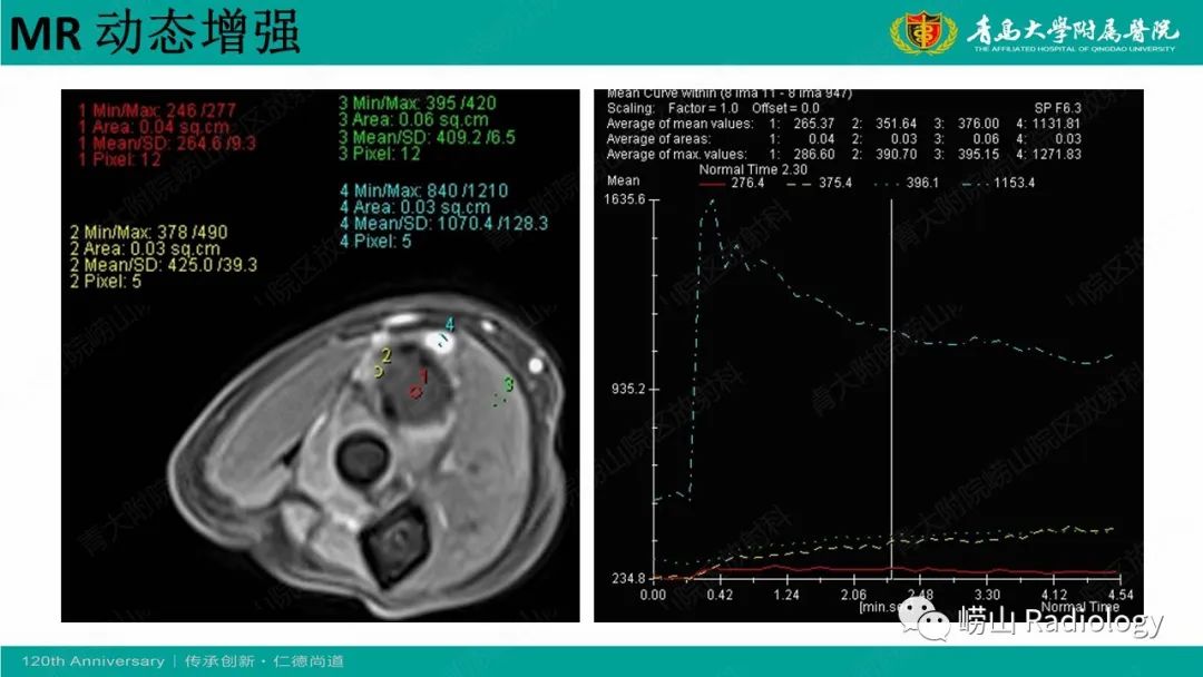 影像PPT - 【病例】肘关节腱鞘纤维瘤1例X线CT及MR-10