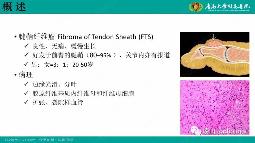 影像PPT - 【病例】肘关节腱鞘纤维瘤1例X线CT及MR-16