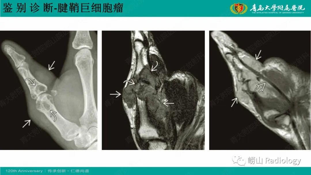 影像PPT - 【病例】肘关节腱鞘纤维瘤1例X线CT及MR-20