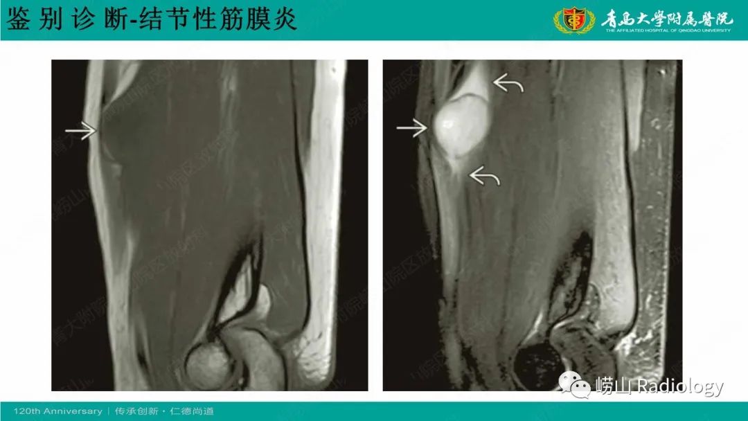 影像PPT - 【病例】肘关节腱鞘纤维瘤1例X线CT及MR-22