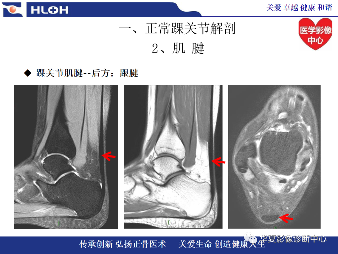 影像PPT - 【PPT】踝关节病变的MRI诊断-13