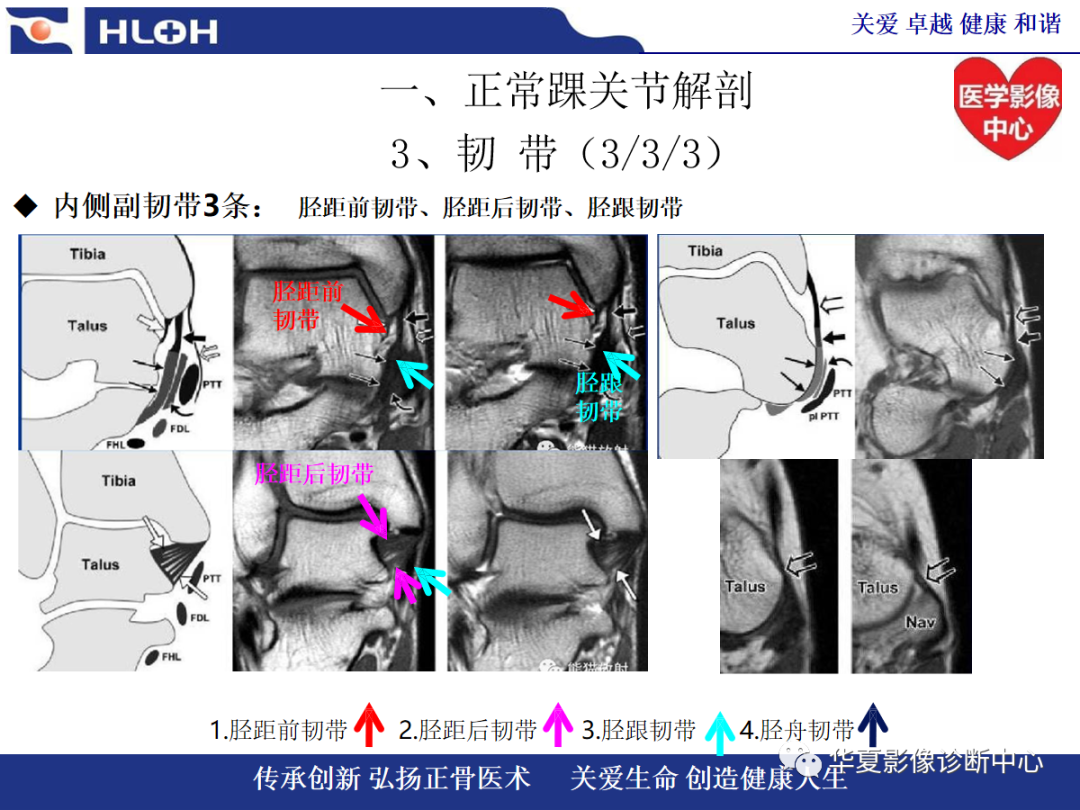 影像PPT - 【PPT】踝关节病变的MRI诊断-18