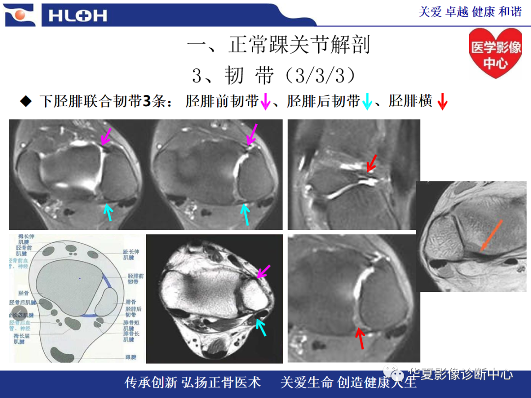 影像PPT - 【PPT】踝关节病变的MRI诊断-24