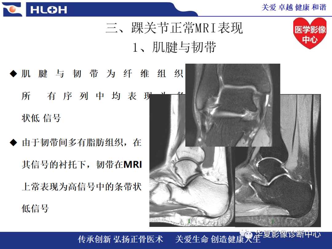 影像PPT - 【PPT】踝关节病变的MRI诊断-32