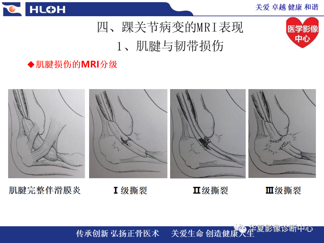 影像PPT - 【PPT】踝关节病变的MRI诊断-37