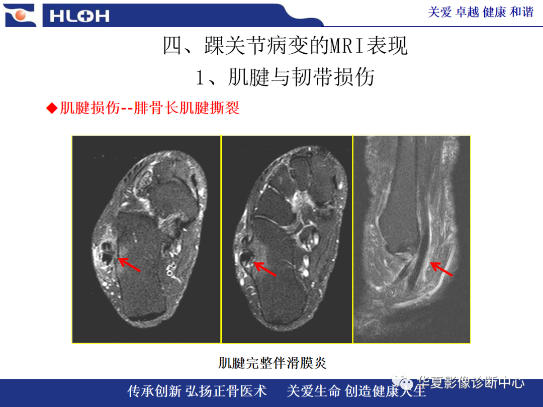 影像PPT - 【PPT】踝关节病变的MRI诊断-39