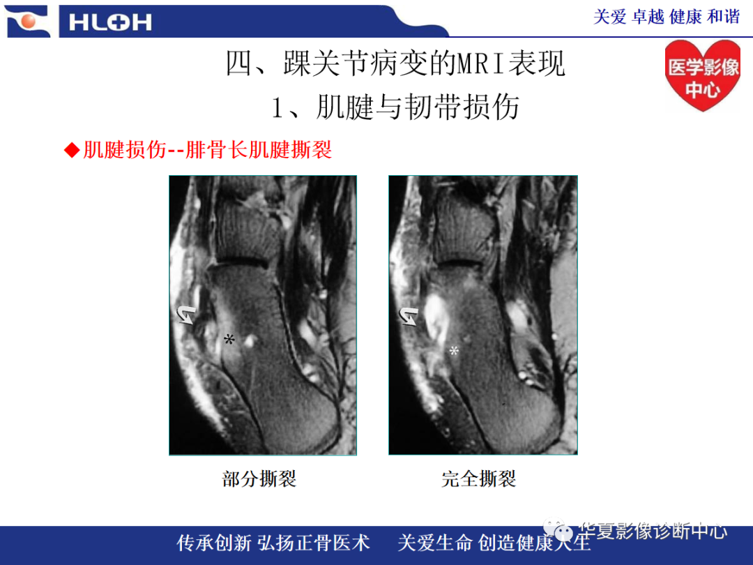 影像PPT - 【PPT】踝关节病变的MRI诊断-48