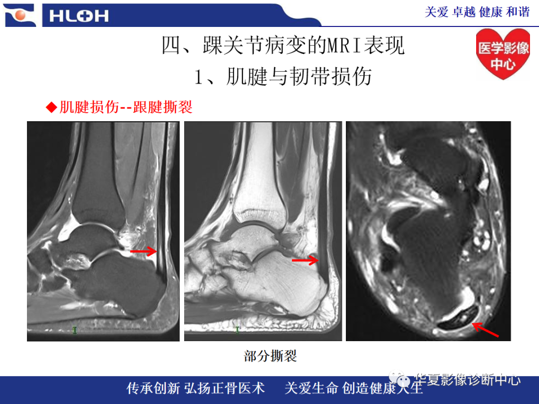 影像PPT - 【PPT】踝关节病变的MRI诊断-53