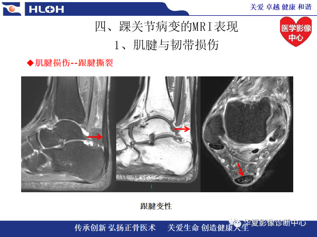 影像PPT - 【PPT】踝关节病变的MRI诊断-52